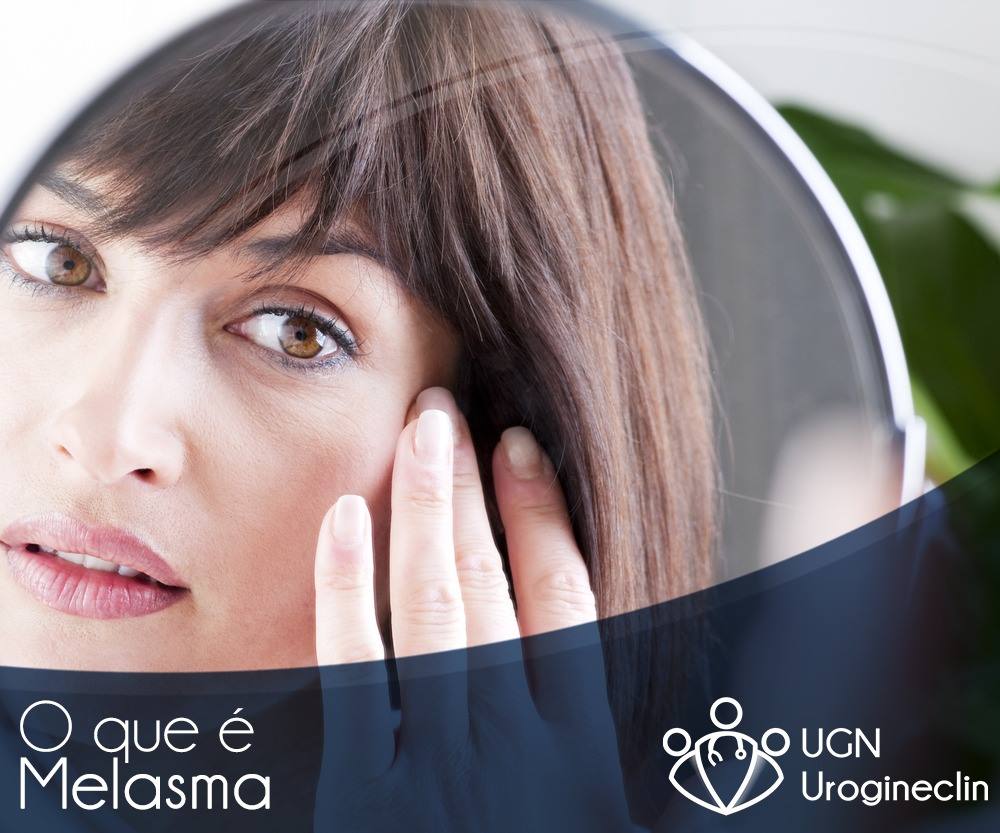 O que é Melasma?